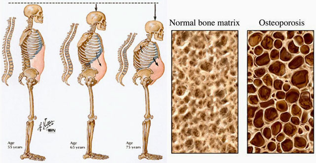 Fosamax Alendronate for osteoporosis